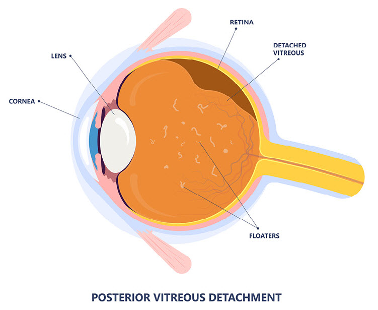 Posterior Vitreous Detachment Eye Care Specialists of Michigan Posterior Vitreous Detachment Eye Care Specialists of Michigan